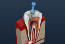 What are the different stages of the Root Canal Treatment Root Canal Treatment
