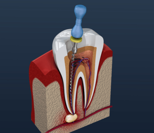 Root Canal Treatment
