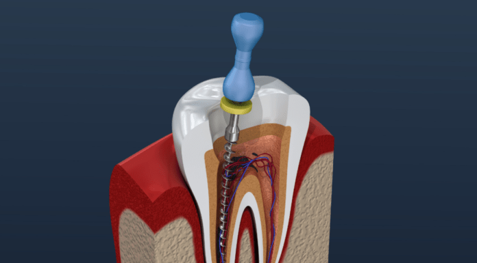 Root Canal Treatment